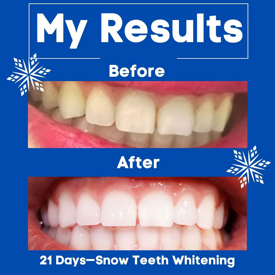 SNOW® Teeth Whitening